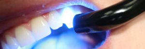 implant dentaire à l’étranger